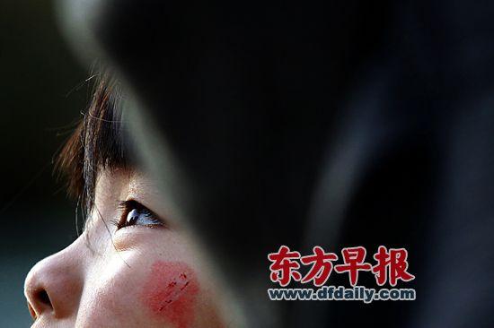 昨日，复旦大学附属儿科医院，7岁女童若若(化名)左边脸颊还留有被划破的伤痕。