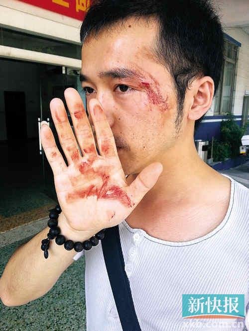本报一记者眼角被打伤，流血不止。