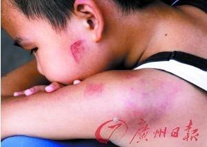 广州7岁孩子课堂上被老师用铁尺打5次 确诊颅脑外伤（图）