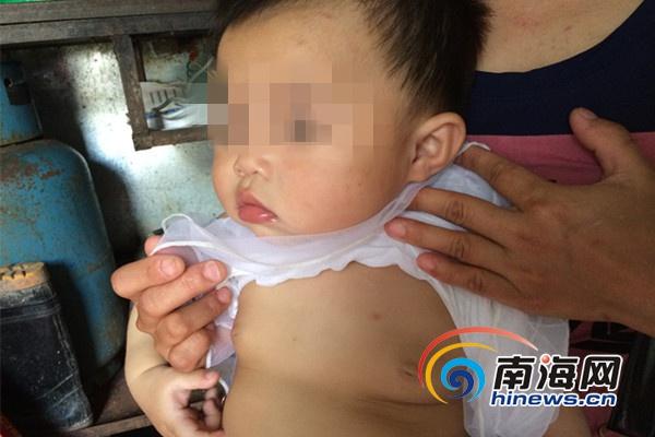 1岁女婴胸部早育 家长疑系食用“韩国原装进口奶粉”(图)