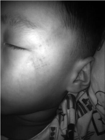 男童因午休不睡遭老师用苍蝇拍抽打 致面部耳朵红肿（图）