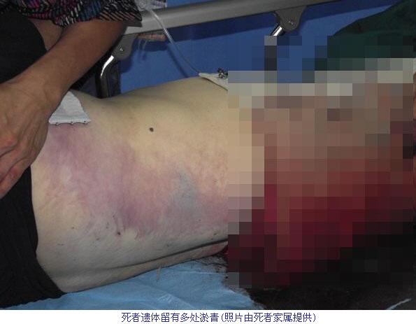 福州女子被山东铁警跨省调查 3小时后死亡身上有淤青（图）