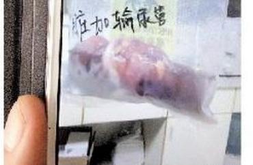 深圳女工尿道结石做手术被摘肾 回应称患者同意（图）