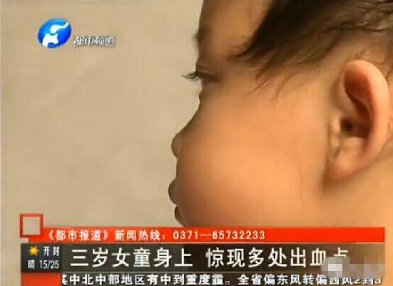 河南3岁女童被幼师全身扎针 疑因贪玩不愿睡午觉(视频/图)