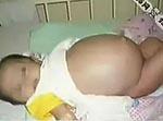 天下奇闻！七个月男婴竟“怀孕” 剖腹产下一名女婴(组图)