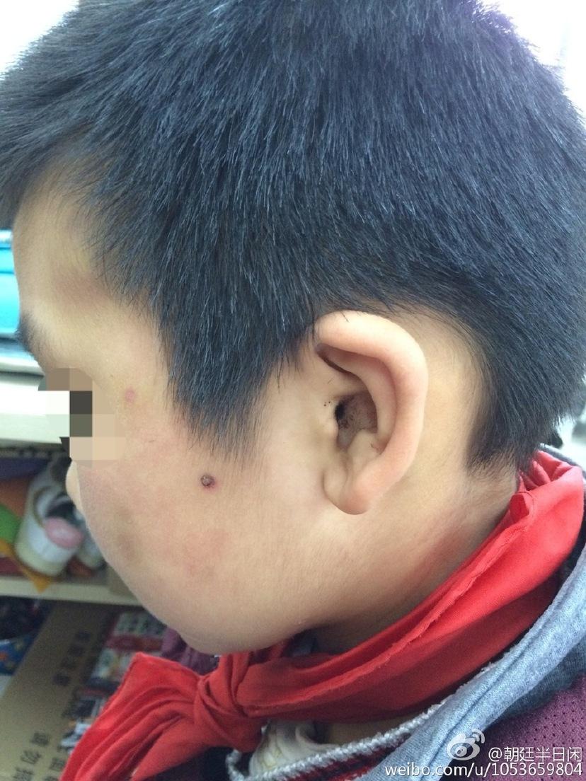 南京9岁男童遭虐待伤痕累累 曝遭虐男童父母系高知/组图