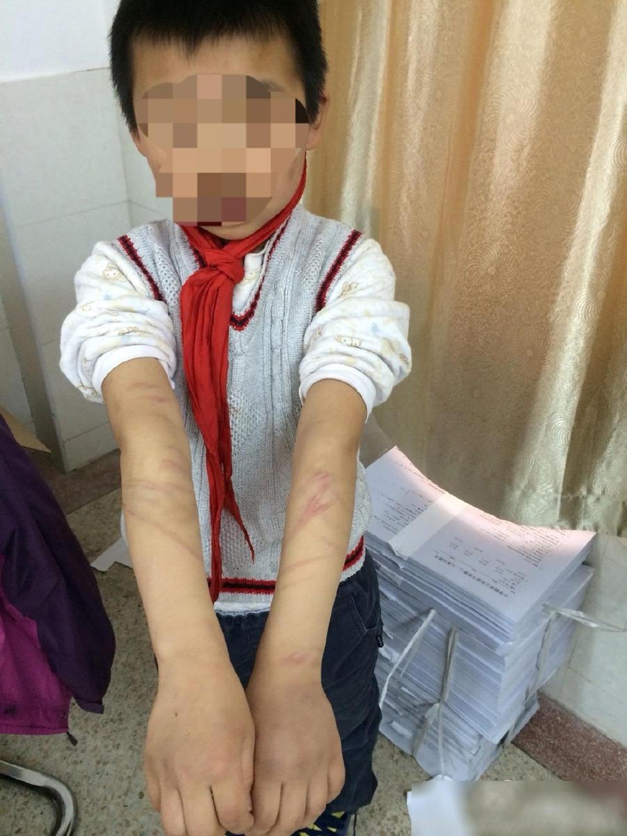 南京9岁男童遭虐待伤痕累累 曝遭虐男童父母系高知/组图