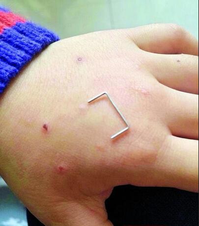 男童遭老师针扎 手上伤口如订书针状伤痕清晰可见