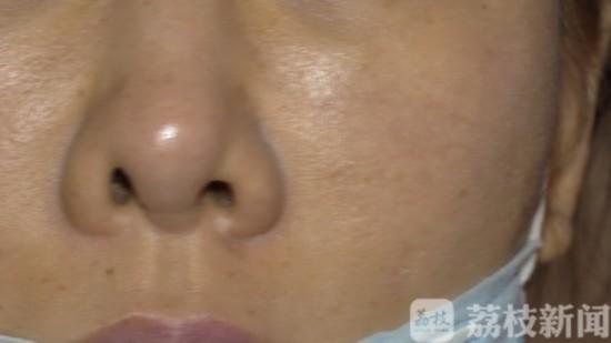 女子在南京施尔美整形医院隆鼻后鼻子歪了 修复后更歪了
