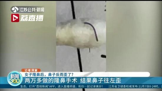 女子在南京韩辰整形医院花了两万多整形后鼻子歪了