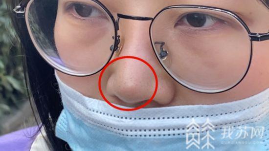 女子在南京侨台医疗美容院隆鼻后鼻头凸起 卫监介入调查